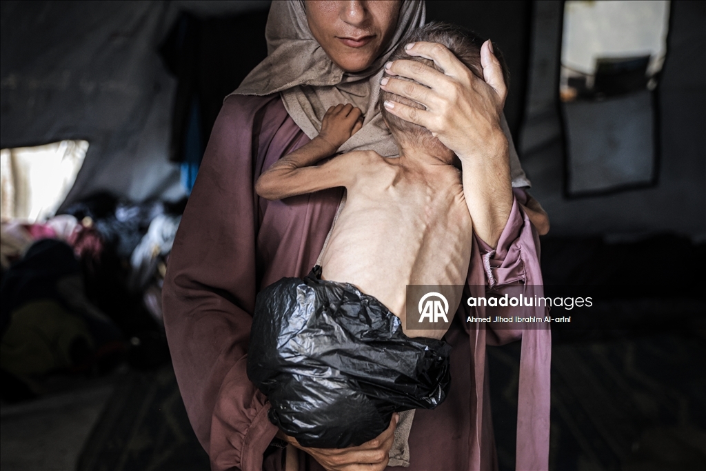 Malnourished toddler in Gaza fights for life amid ongoing Israeli attacks