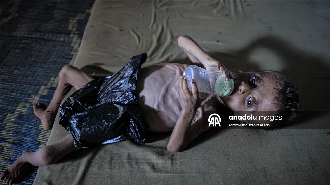 Malnourished toddler in Gaza fights for life amid ongoing Israeli attacks