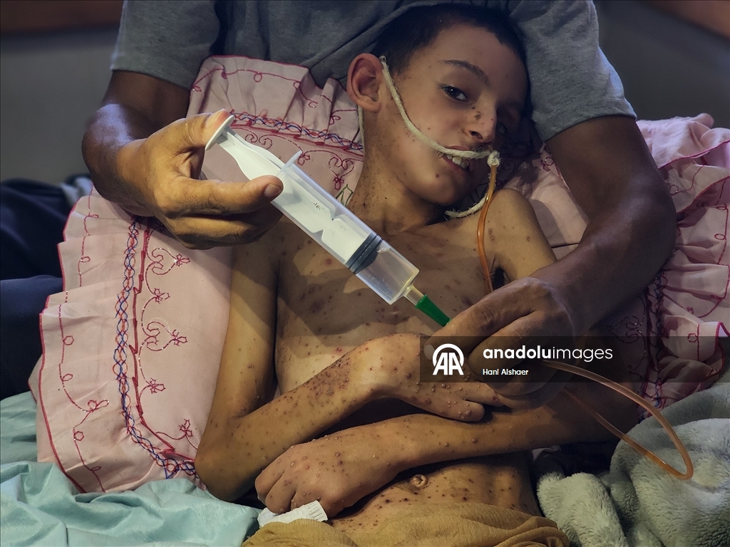İsrail saldırısında felç kalan Gazzeli çocuk, yetersiz beslenme ve cilt hastalığıyla mücadele ediyor