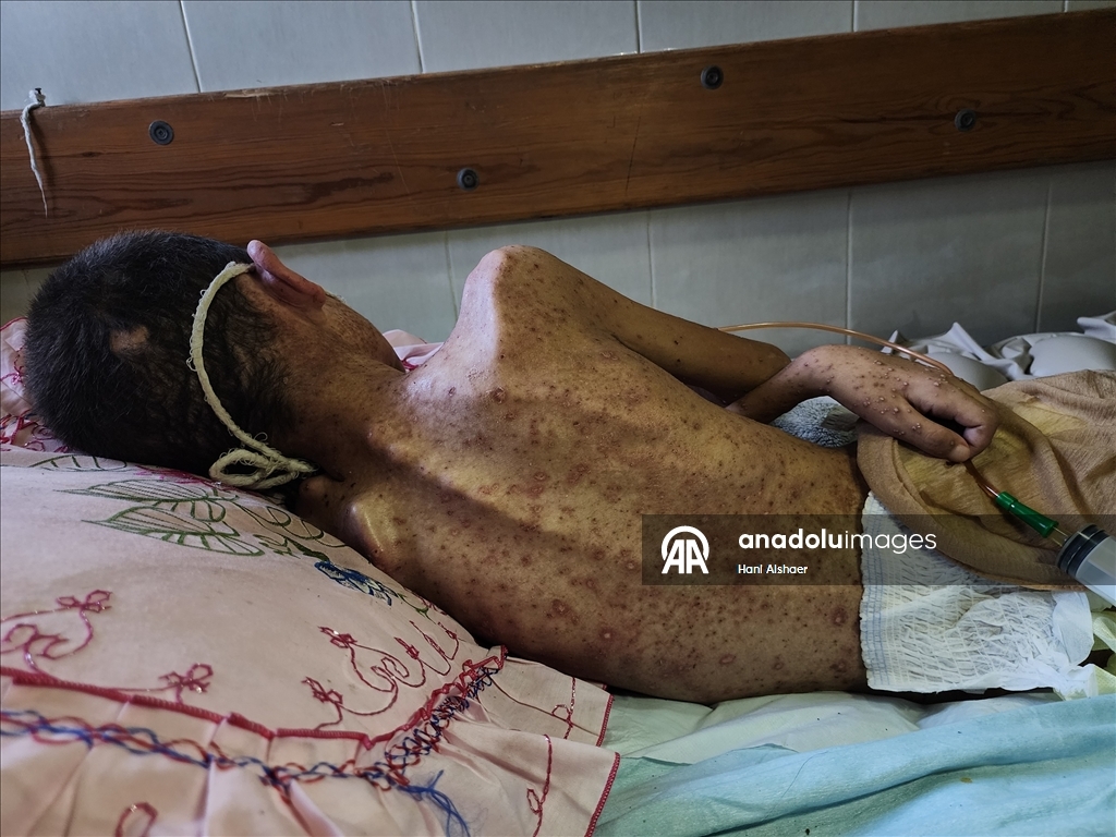 İsrail saldırısında felç kalan Gazzeli çocuk, yetersiz beslenme ve cilt hastalığıyla mücadele ediyor