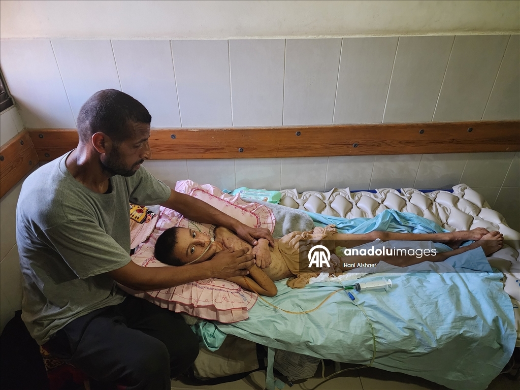 İsrail saldırısında felç kalan Gazzeli çocuk, yetersiz beslenme ve cilt hastalığıyla mücadele ediyor