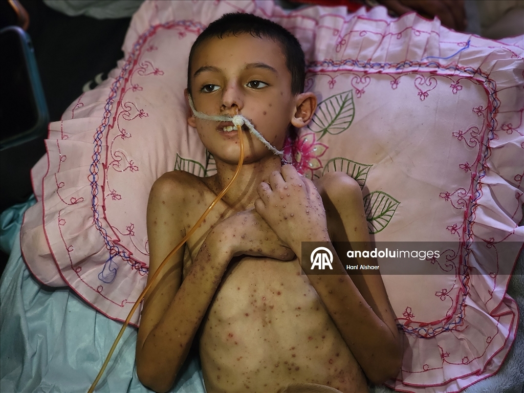 İsrail saldırısında felç kalan Gazzeli çocuk, yetersiz beslenme ve cilt hastalığıyla mücadele ediyor