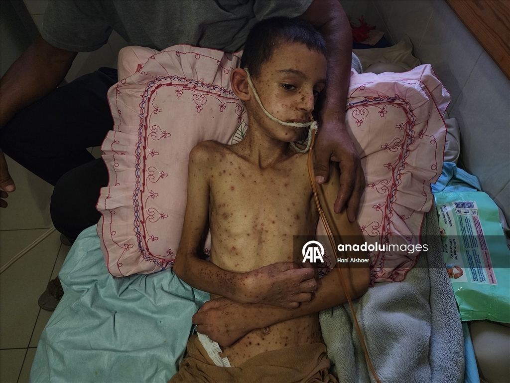 İsrail saldırısında felç kalan Gazzeli çocuk, yetersiz beslenme ve cilt hastalığıyla mücadele ediyor