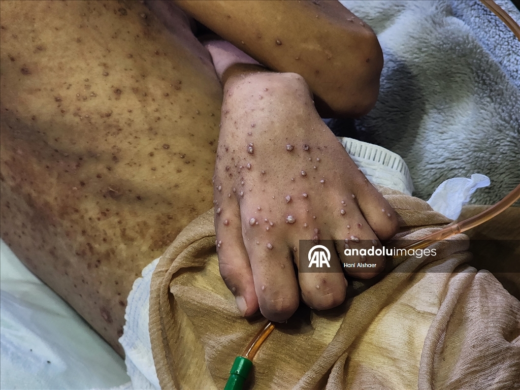 İsrail saldırısında felç kalan Gazzeli çocuk, yetersiz beslenme ve cilt hastalığıyla mücadele ediyor