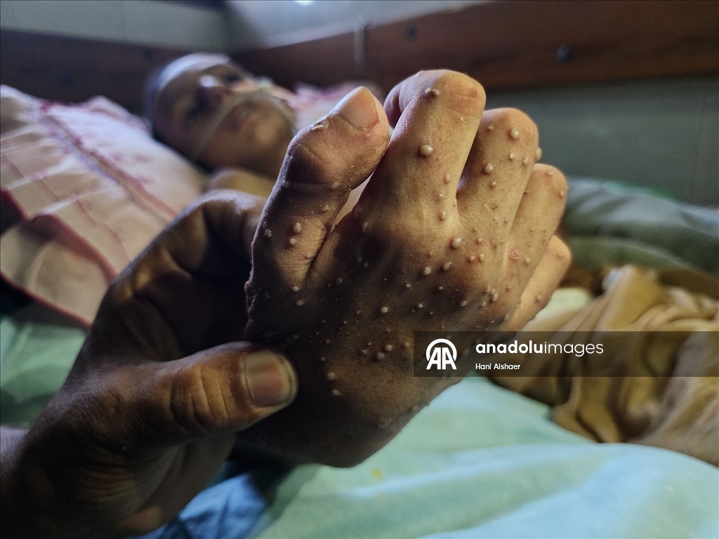 İsrail saldırısında felç kalan Gazzeli çocuk, yetersiz beslenme ve cilt hastalığıyla mücadele ediyor