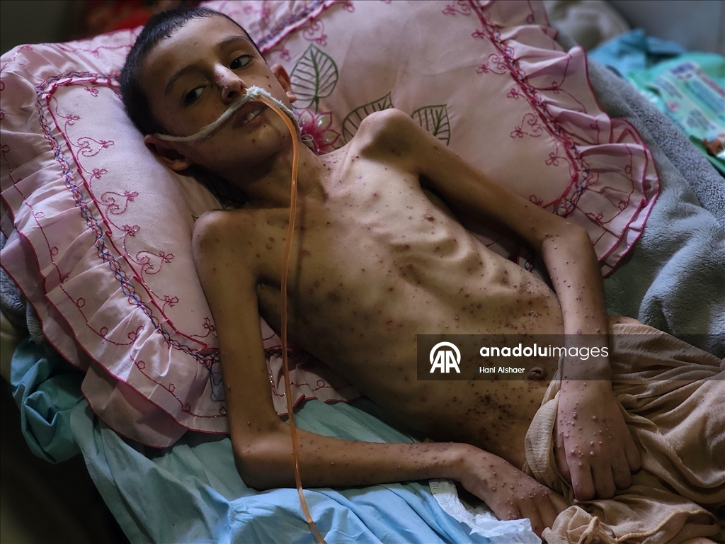 İsrail saldırısında felç kalan Gazzeli çocuk, yetersiz beslenme ve cilt hastalığıyla mücadele ediyor