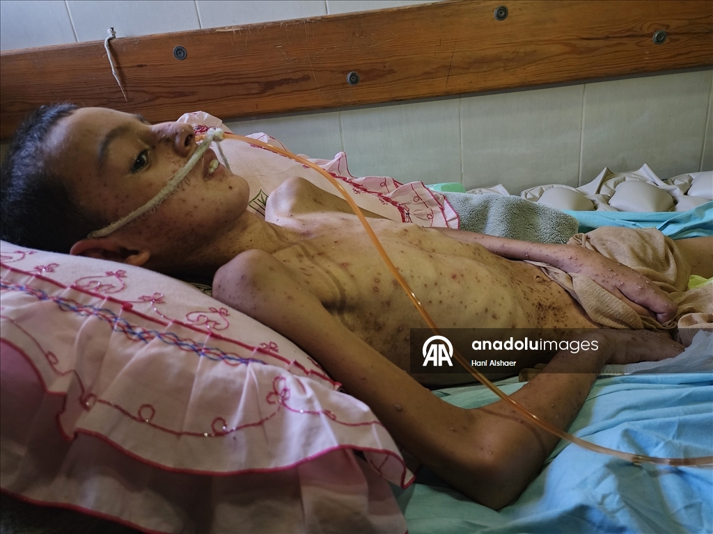 İsrail saldırısında felç kalan Gazzeli çocuk, yetersiz beslenme ve cilt hastalığıyla mücadele ediyor