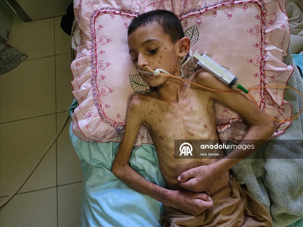 İsrail saldırısında felç kalan Gazzeli çocuk, yetersiz beslenme ve cilt hastalığıyla mücadele ediyor
