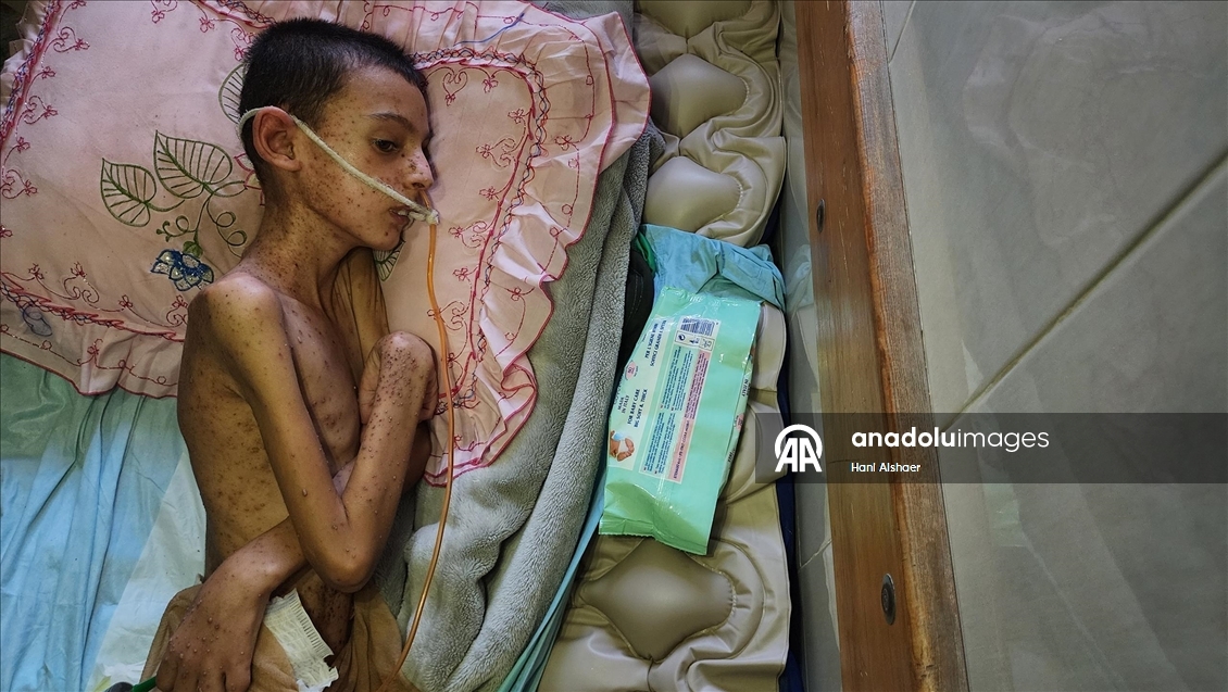 İsrail saldırısında felç kalan Gazzeli çocuk, yetersiz beslenme ve cilt hastalığıyla mücadele ediyor