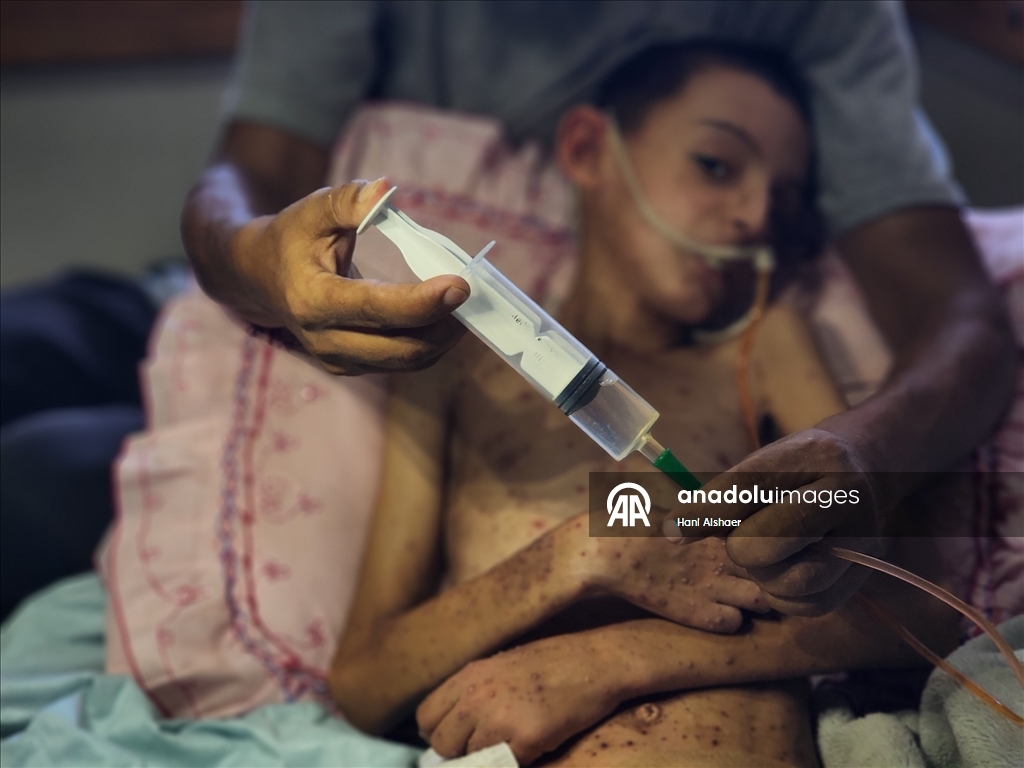 İsrail saldırısında felç kalan Gazzeli çocuk, yetersiz beslenme ve cilt hastalığıyla mücadele ediyor