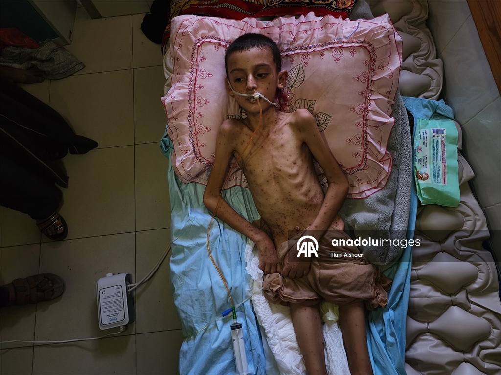 İsrail saldırısında felç kalan Gazzeli çocuk, yetersiz beslenme ve cilt hastalığıyla mücadele ediyor