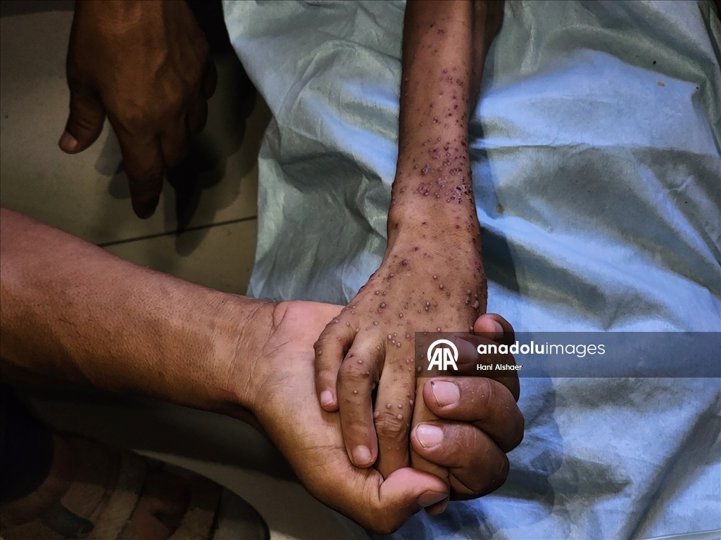 İsrail saldırısında felç kalan Gazzeli çocuk, yetersiz beslenme ve cilt hastalığıyla mücadele ediyor