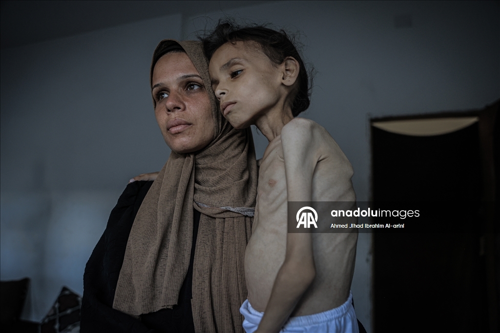 Palestinska djevojčica zbog gladi u Gazi spala na devet kilograma, ne može ni da hoda