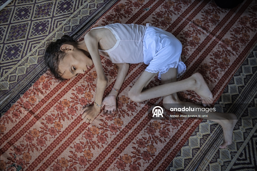 Palestinska djevojčica zbog gladi u Gazi spala na devet kilograma, ne može ni da hoda