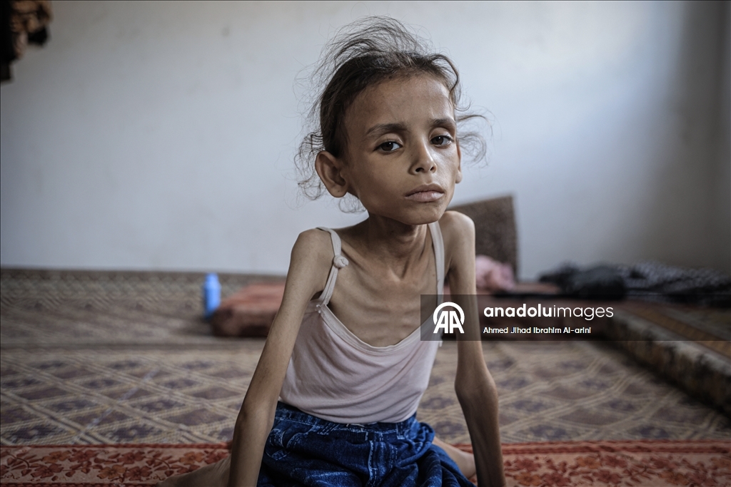 Palestinska djevojčica zbog gladi u Gazi spala na devet kilograma, ne može ni da hoda