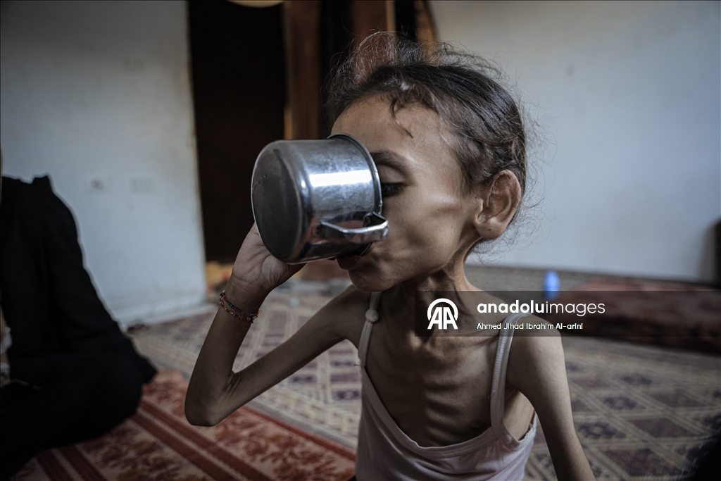Palestinska djevojčica zbog gladi u Gazi spala na devet kilograma, ne može ni da hoda