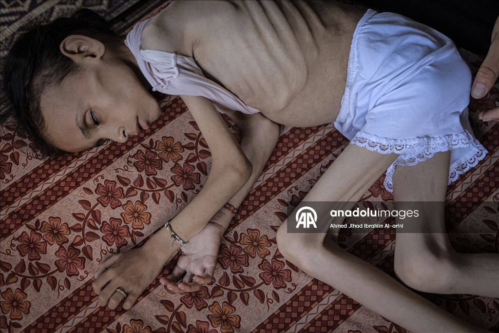 Palestinska djevojčica zbog gladi u Gazi spala na devet kilograma, ne može ni da hoda