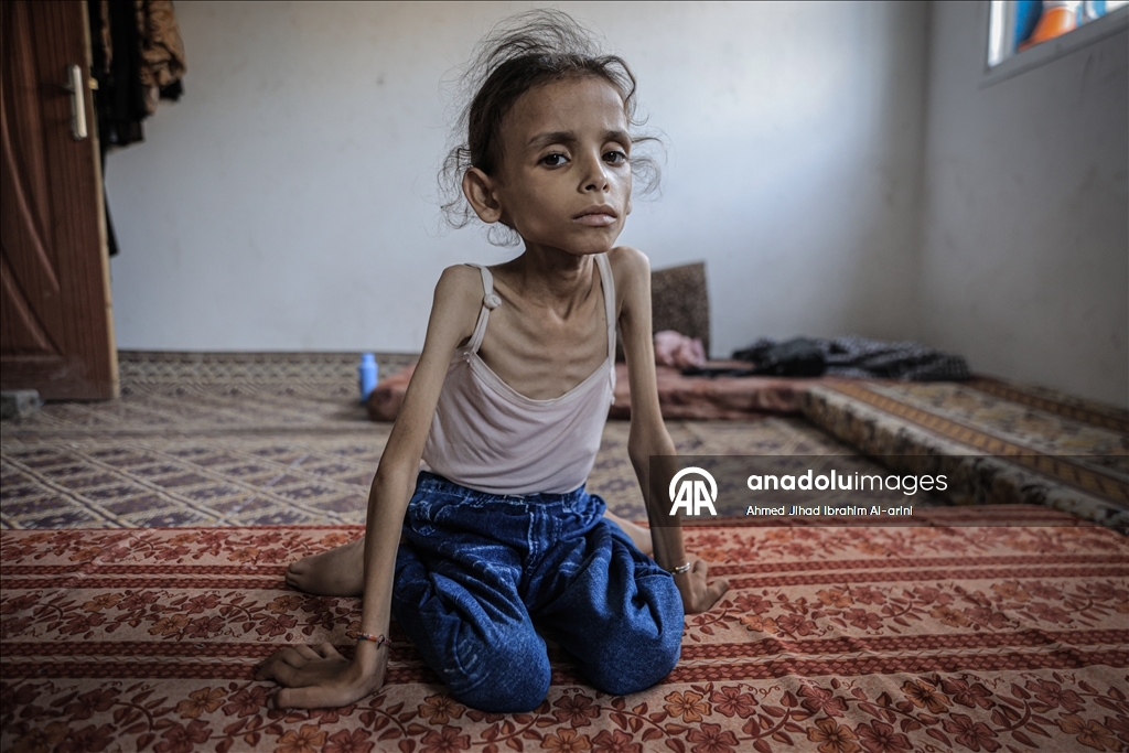 Palestinska djevojčica zbog gladi u Gazi spala na devet kilograma, ne može ni da hoda