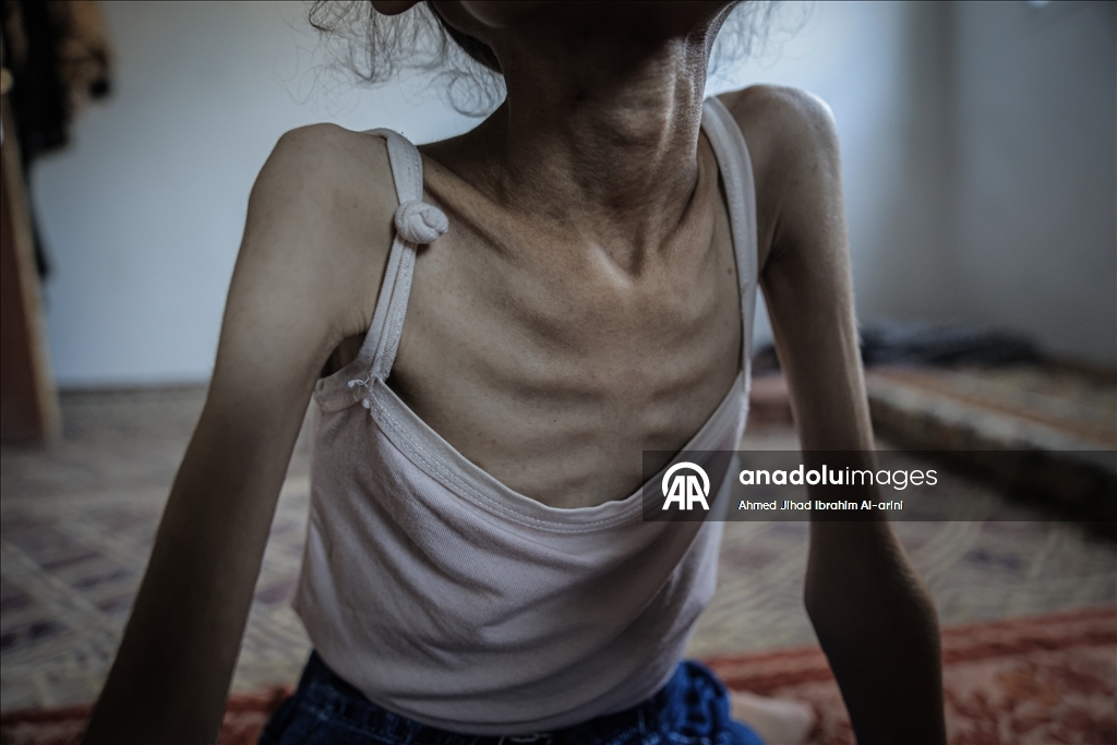 Palestinska djevojčica zbog gladi u Gazi spala na devet kilograma, ne može ni da hoda