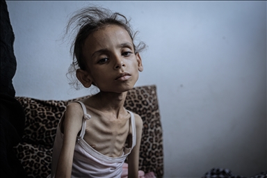 Palestinska djevojčica zbog gladi u Gazi spala na devet kilograma, ne može ni da hoda
