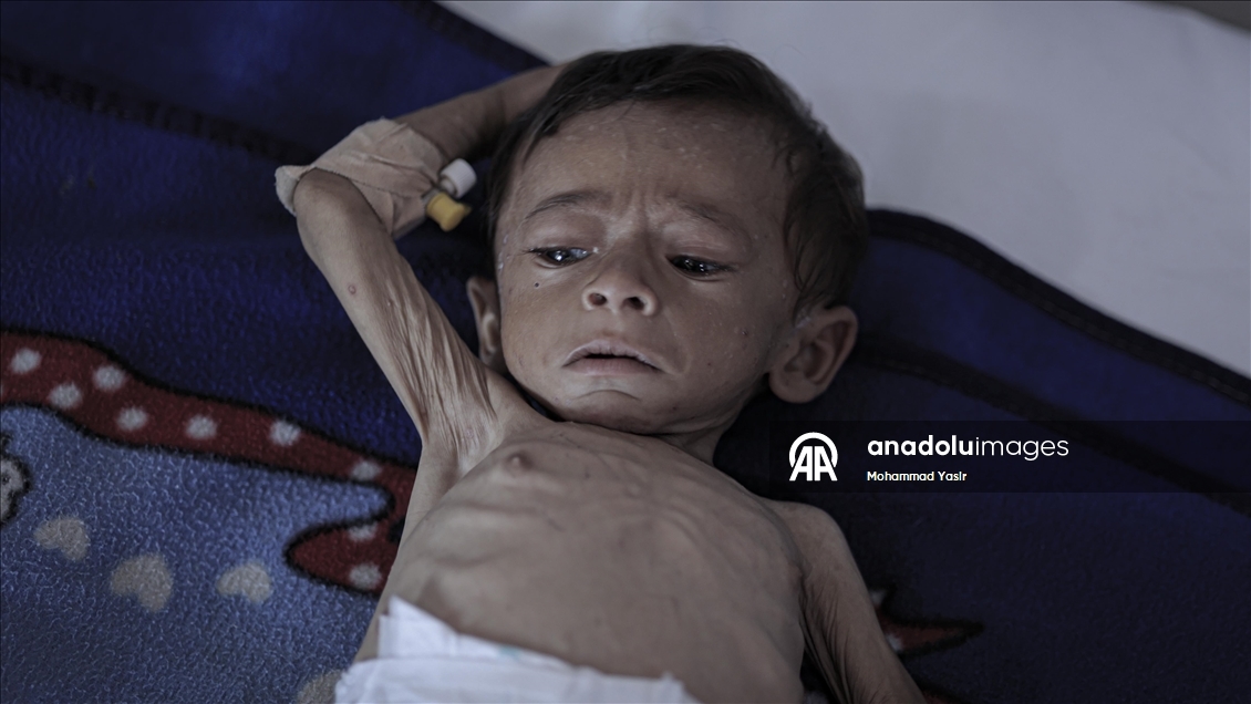 7-month-old baby’s life at risk in Gaza as Israeli blockade drives region to famine