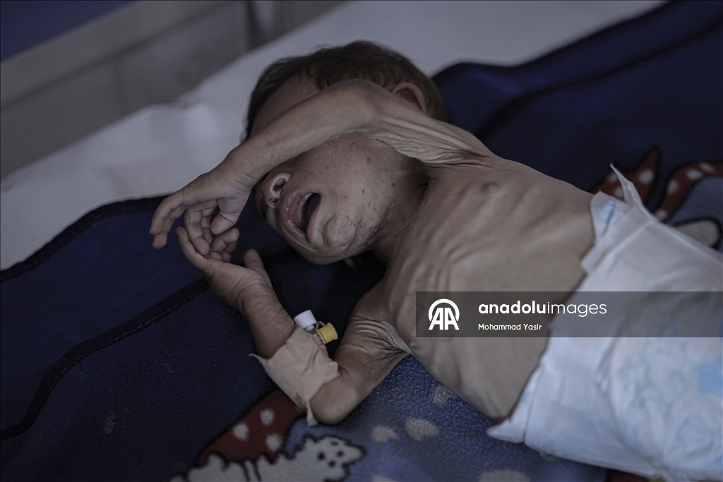 7-month-old baby’s life at risk in Gaza as Israeli blockade drives region to famine