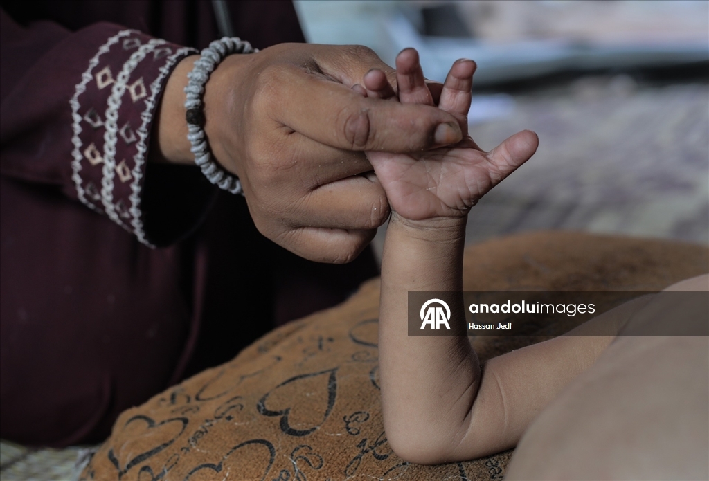 Gazze’de 3 yaşındaki bebek açlık nedeniyle hayati tehlike altında