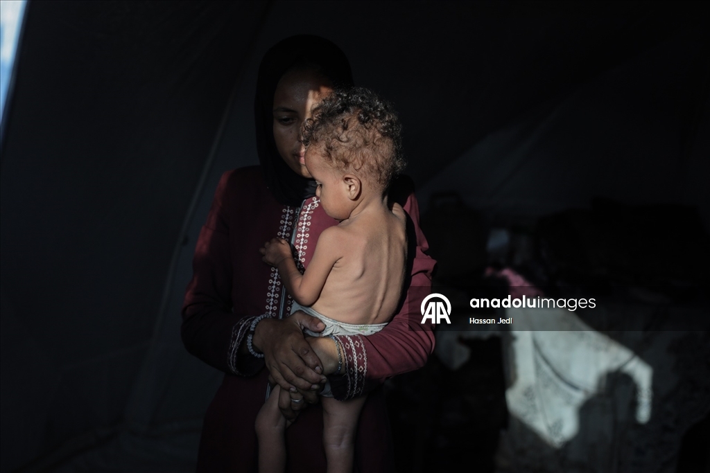 Gazze’de 3 yaşındaki bebek açlık nedeniyle hayati tehlike altında