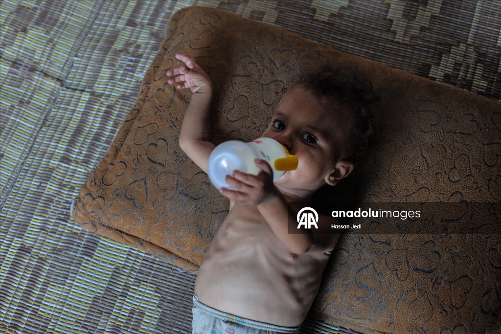 Gazze’de 3 yaşındaki bebek açlık nedeniyle hayati tehlike altında