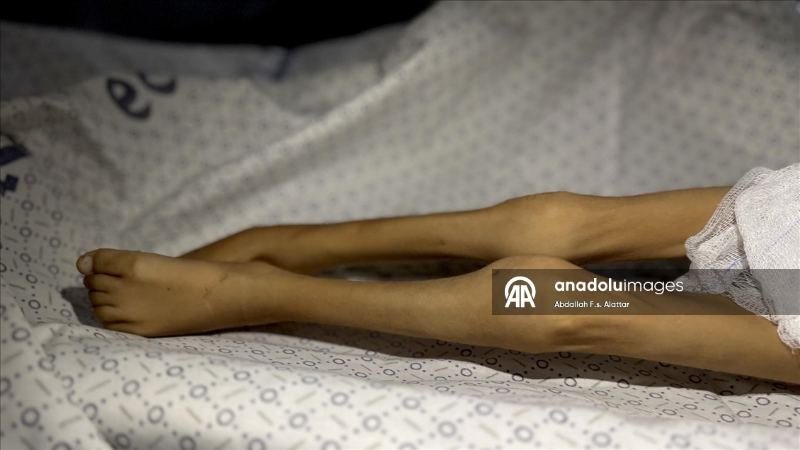 Gazze'de yetersiz beslenme nedeniyle bir çocuk daha hayatını kaybetti