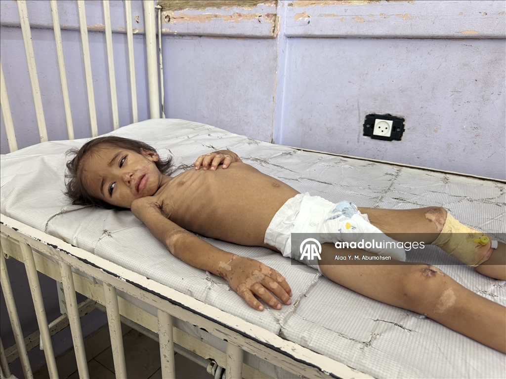 İsrail'in açlığa mahkum ettiği Gazze'de 2 yaşındaki çocuk, yaşam mücadelesi veriyor