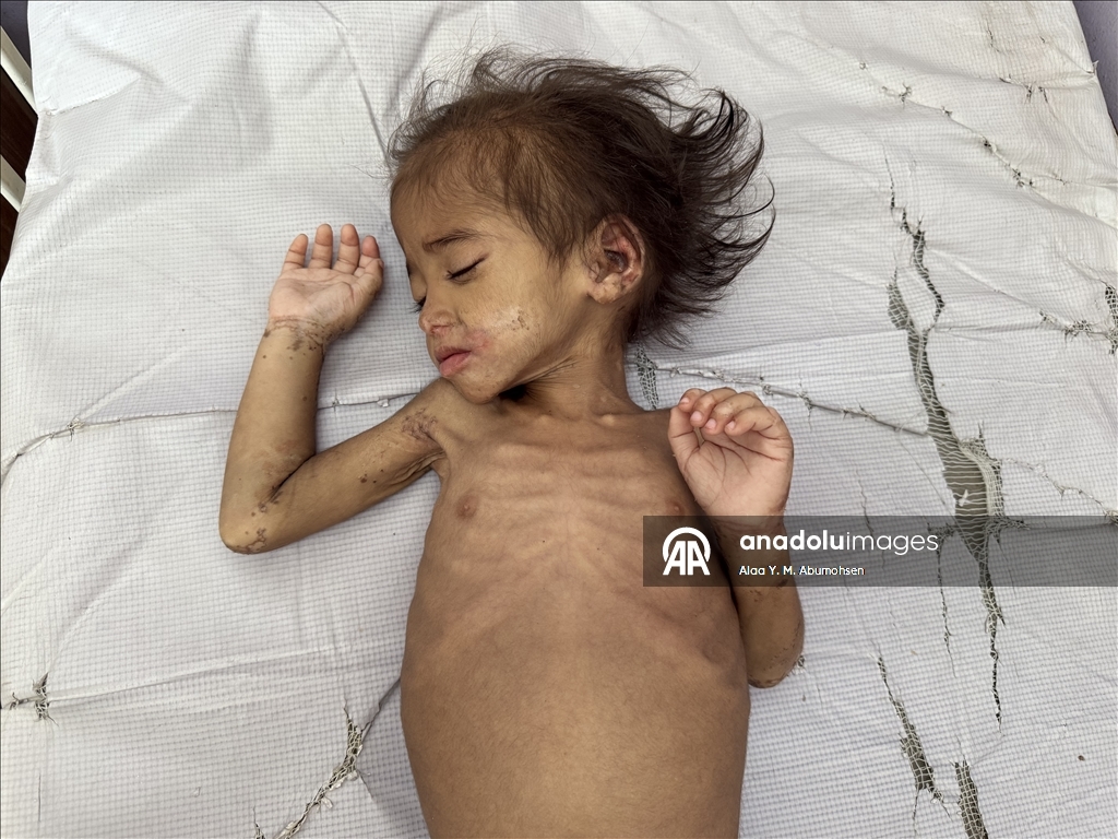 İsrail'in açlığa mahkum ettiği Gazze'de 2 yaşındaki çocuk, yaşam mücadelesi veriyor