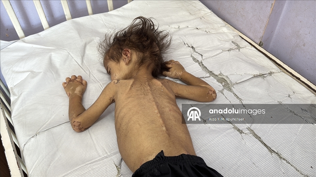 İsrail'in açlığa mahkum ettiği Gazze'de 2 yaşındaki çocuk, yaşam mücadelesi veriyor