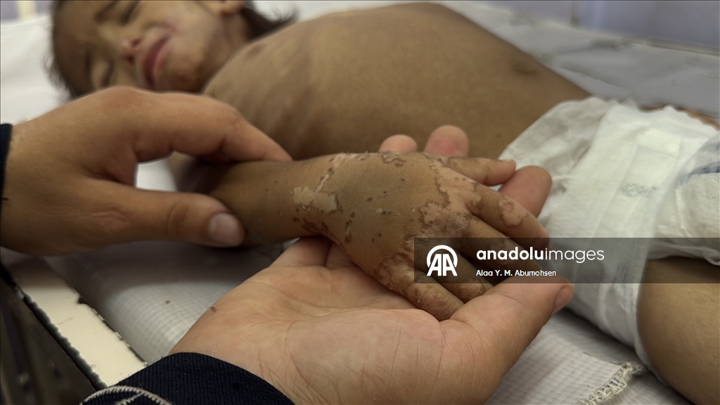 İsrail'in açlığa mahkum ettiği Gazze'de 2 yaşındaki çocuk, yaşam mücadelesi veriyor