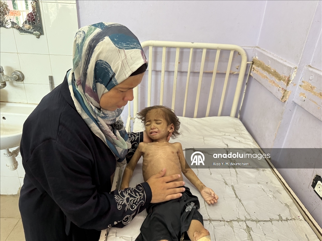 İsrail'in açlığa mahkum ettiği Gazze'de 2 yaşındaki çocuk, yaşam mücadelesi veriyor