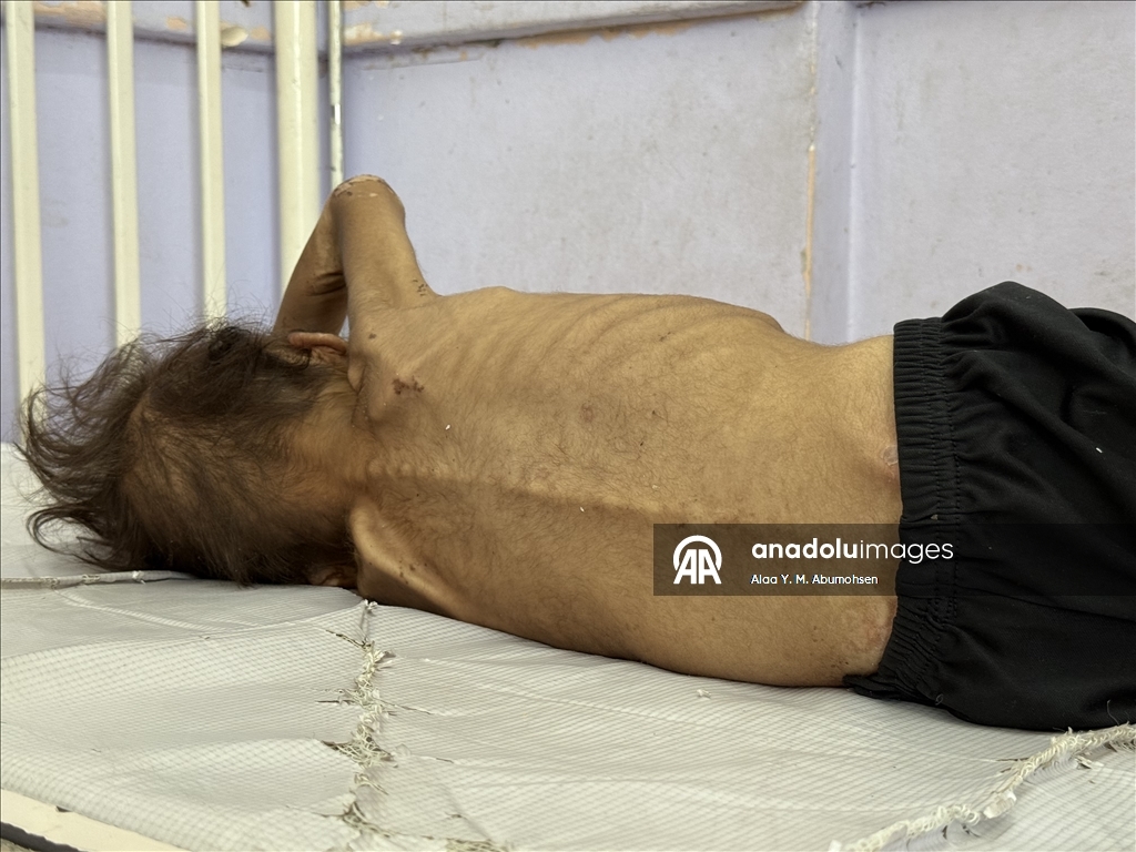 İsrail'in açlığa mahkum ettiği Gazze'de 2 yaşındaki çocuk, yaşam mücadelesi veriyor