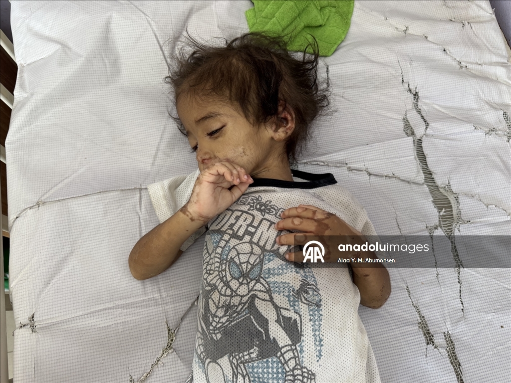 İsrail'in açlığa mahkum ettiği Gazze'de 2 yaşındaki çocuk, yaşam mücadelesi veriyor