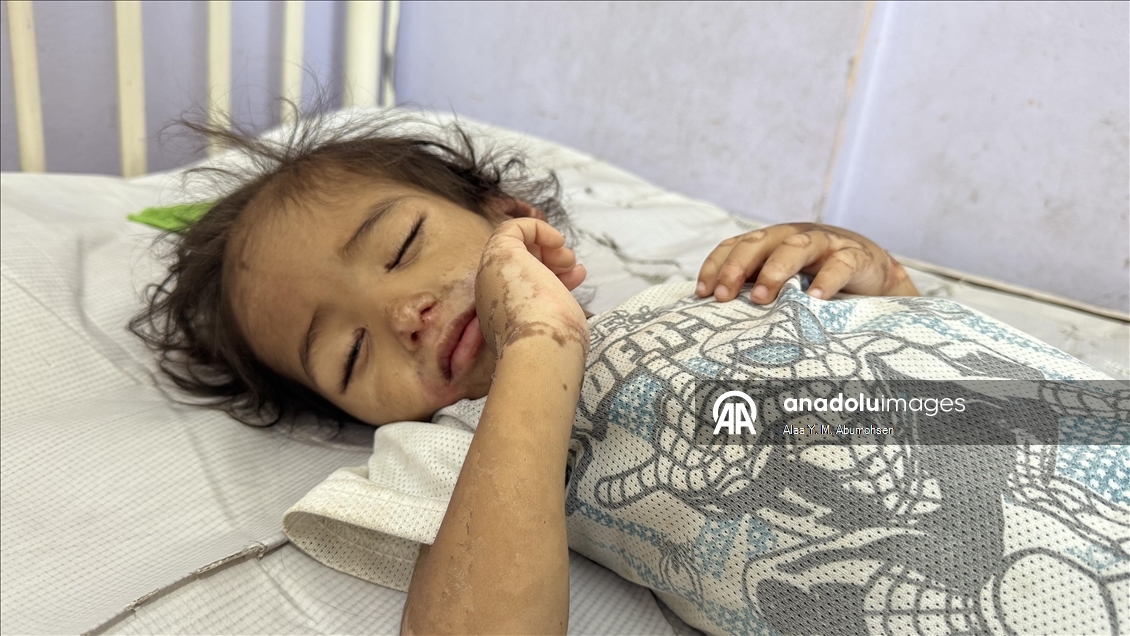 İsrail'in açlığa mahkum ettiği Gazze'de 2 yaşındaki çocuk, yaşam mücadelesi veriyor