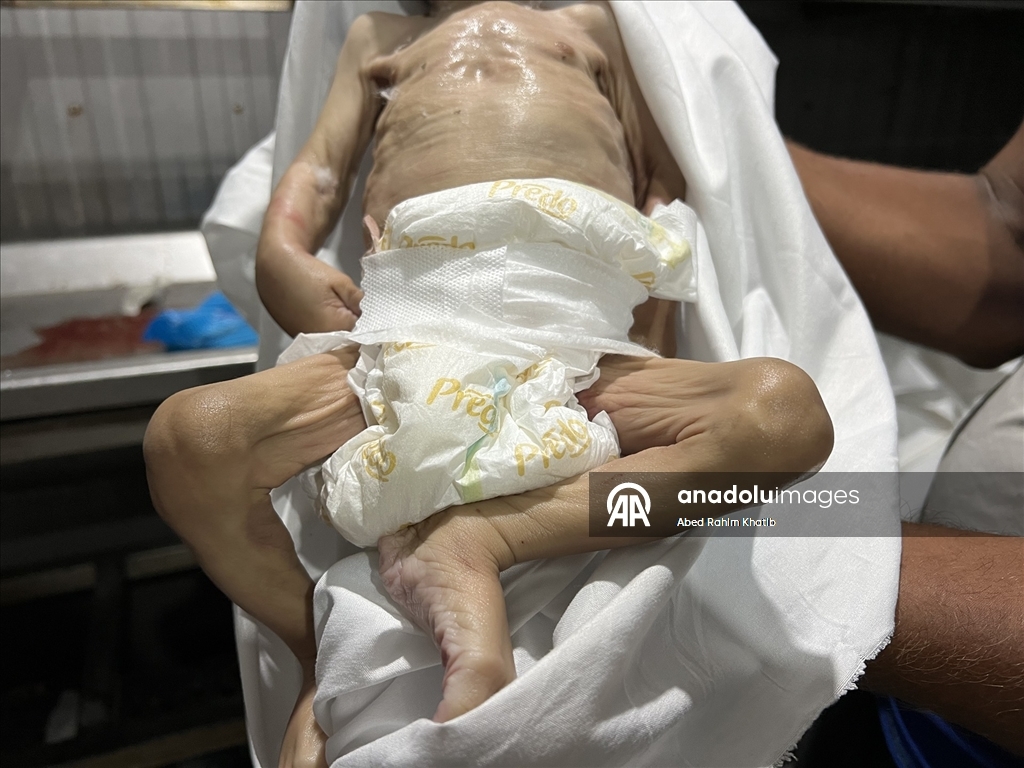 Gazze’de yetersiz beslenme nedeniyle bir bebek daha hayatını kaybetti