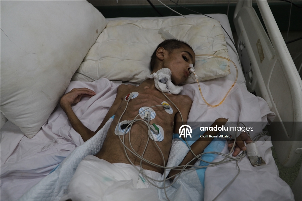 11-летний Ихаб, парализованный после израильского удара, страдает также от недоедания