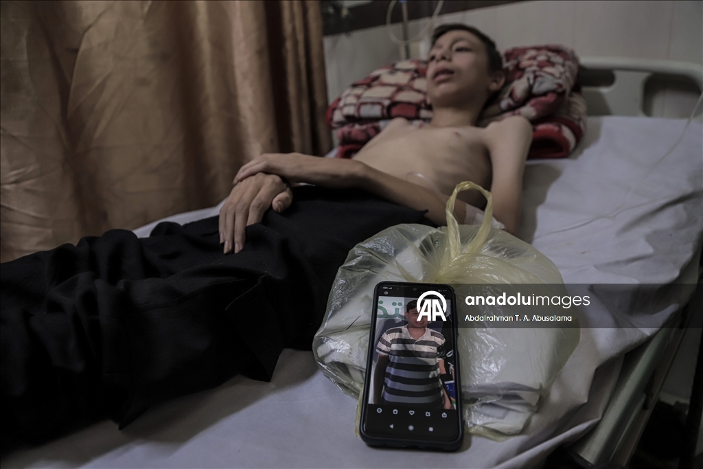 Gazzeli çocuklar, bedenlerinde İsrail soykırımının izlerini taşıyor