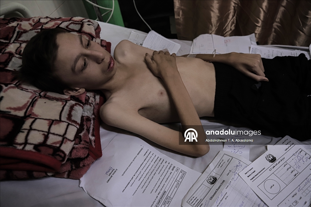 Gazzeli çocuklar, bedenlerinde İsrail soykırımının izlerini taşıyor