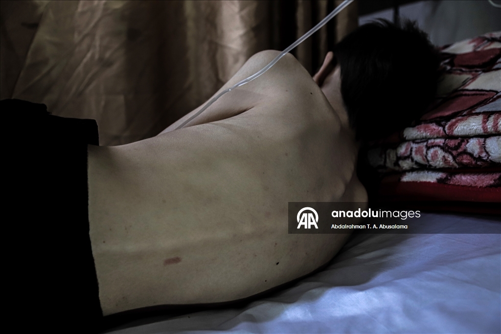 Gazzeli çocuklar, bedenlerinde İsrail soykırımının izlerini taşıyor