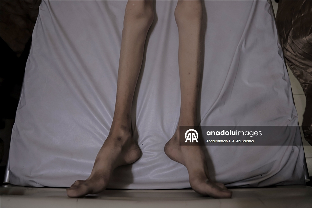 Gazzeli çocuklar, bedenlerinde İsrail soykırımının izlerini taşıyor