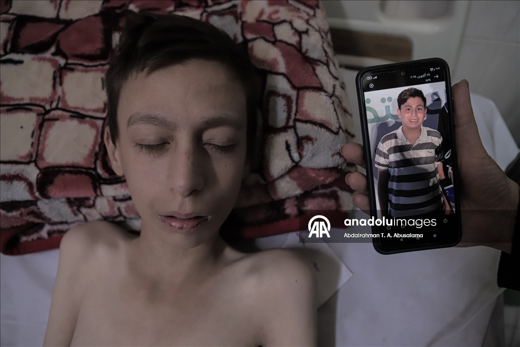 Gazzeli çocuklar, bedenlerinde İsrail soykırımının izlerini taşıyor