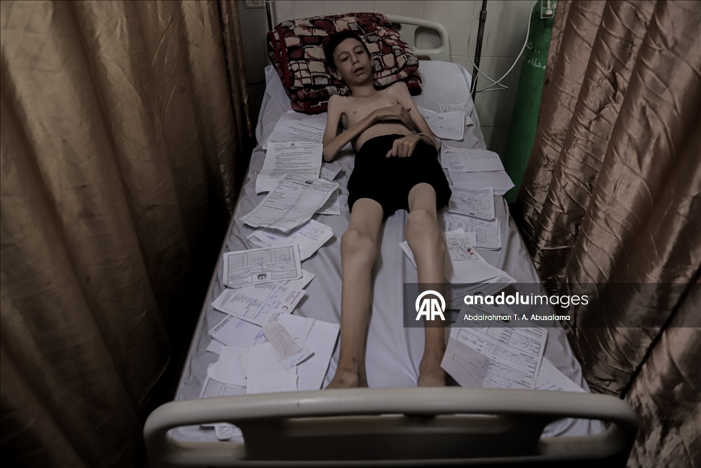 Gazzeli çocuklar, bedenlerinde İsrail soykırımının izlerini taşıyor