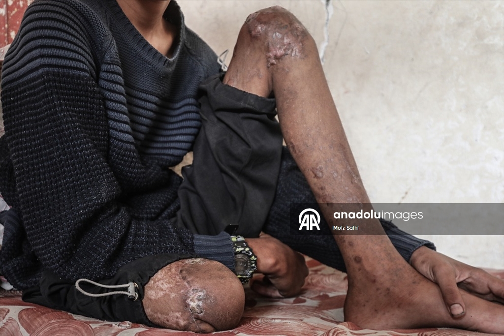 Gazze’de bir bacağını kaybeden Uda’nın diğer bacağı da risk altında