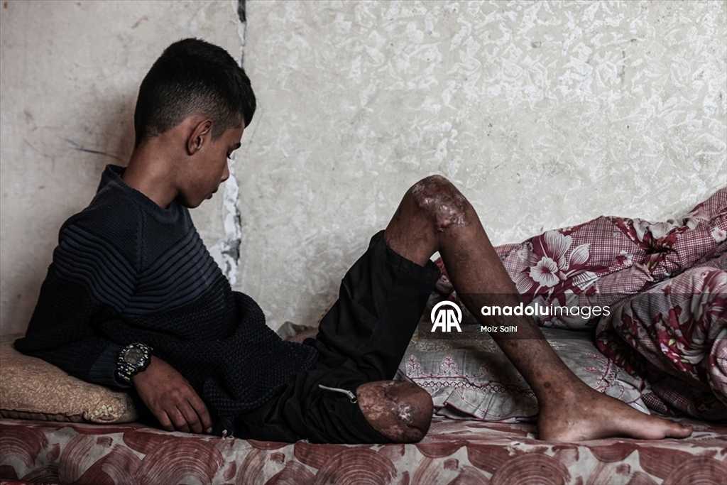 Gazze’de bir bacağını kaybeden Uda’nın diğer bacağı da risk altında