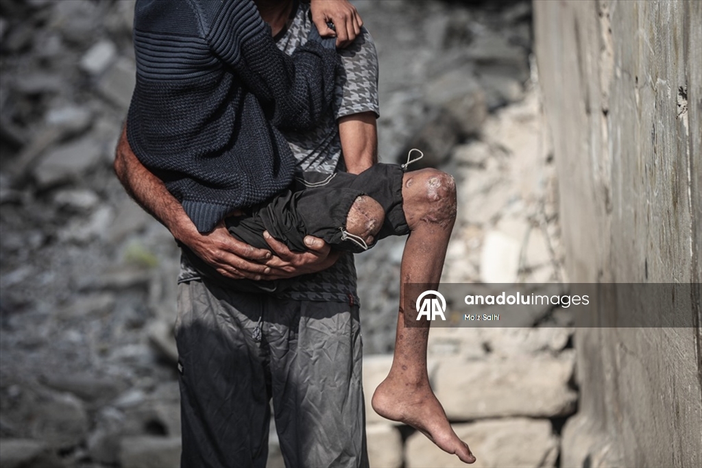 Gazze’de bir bacağını kaybeden Uda’nın diğer bacağı da risk altında