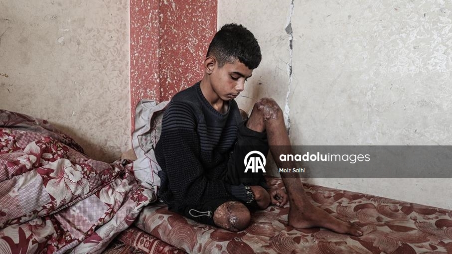 Gazze’de bir bacağını kaybeden Uda’nın diğer bacağı da risk altında